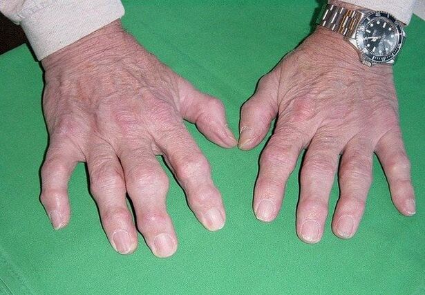 โรคข้อเข่าเสื่อมของนิ้วมือ