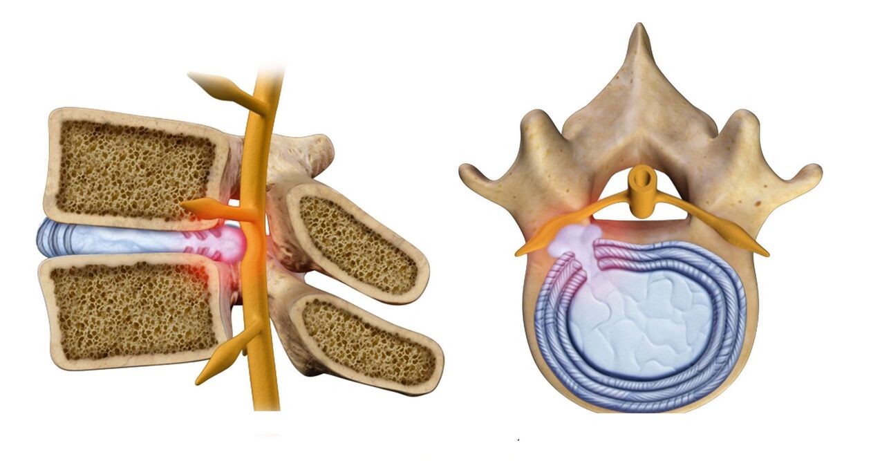 ไส้เลื่อนกระดูกสันหลังในทรวงอก osteochondrosis