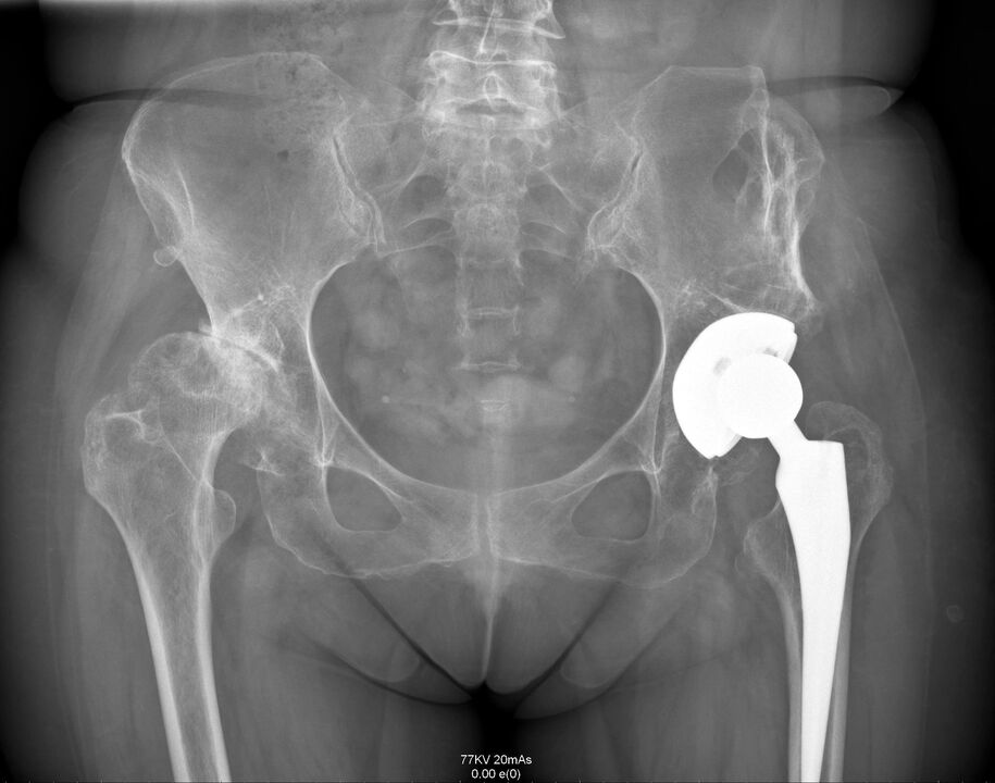 X-ray ของข้อสะโพกหลังการผ่าตัดเปลี่ยนข้อเทียม