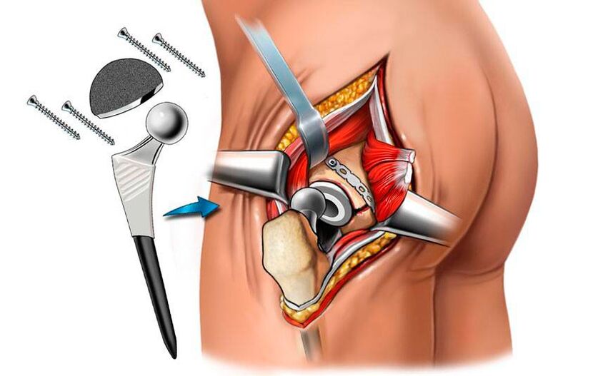 การติดตั้ง endoprosthesis - วิธีการผ่าตัดเพื่อแก้ปัญหา coxarthrosis