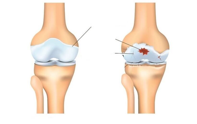มีสุขภาพดีและผู้ป่วยที่มีข้อต่อ arthrosis